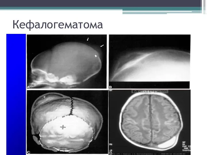 Кефалогематома