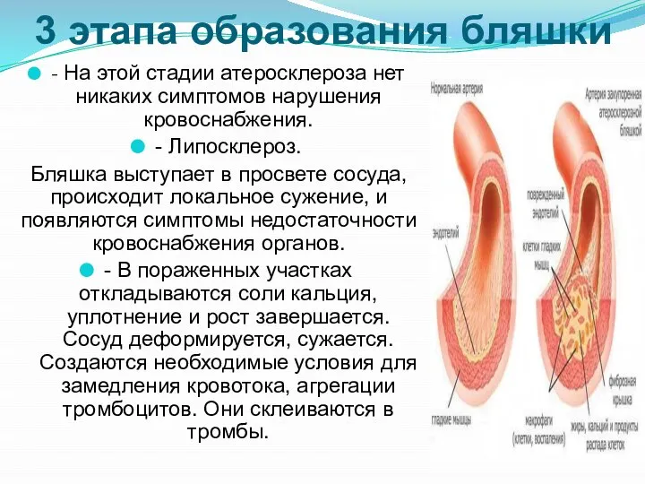 3 этапа образования бляшки - На этой стадии атеросклероза нет никаких