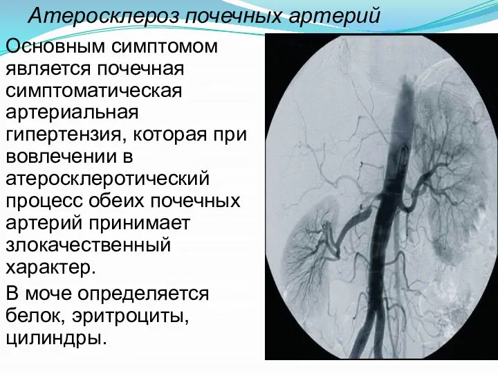 Атеросклероз почечных артерий Основным симптомом является почечная симптоматическая артериальная гипертензия, которая