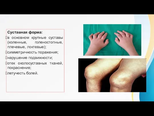 Клинические признаки. Суставная форма: в основном крупные суставы (коленные, голеностопные,плечевые, локтевые);