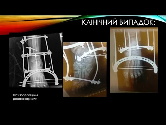 КЛІНІЧНИЙ ВИПАДОК: Післяопераційні рентгенограми