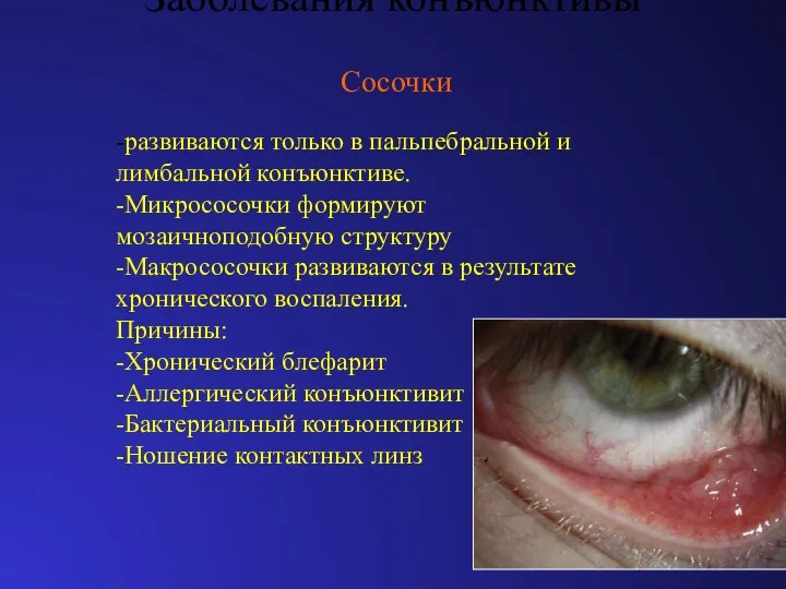 Заболевания конъюнктивы Сосочки -развиваются только в пальпебральной и лимбальной конъюнктиве. -Микрососочки