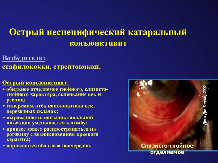 Острый неспецифический катаральный конъюнктивит Возбудители: стафилококки, стрептококки. Острый конъюнктивит: обильное отделяемое