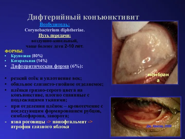 Дифтерийный конъюнктивит Возбудитель: Corynebacterium diphtheriae. Путь передачи: воздушно-капельный, чаще болеют дети