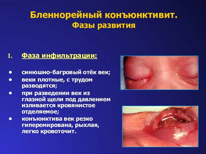 Фаза инфильтрации: синюшно-багровый отёк век; веки плотные, с трудом разводятся; при