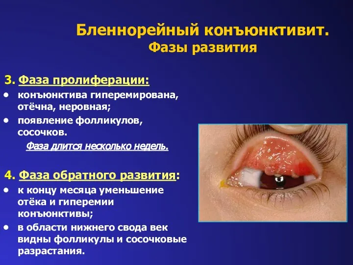 3. Фаза пролиферации: конъюнктива гиперемирована, отёчна, неровная; появление фолликулов, сосочков. Фаза