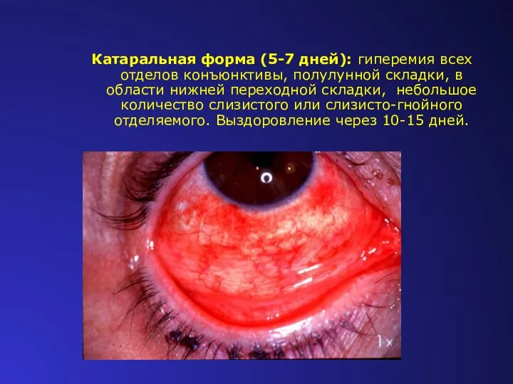 Катаральная форма (5-7 дней): гиперемия всех отделов конъюнктивы, полулунной складки, в