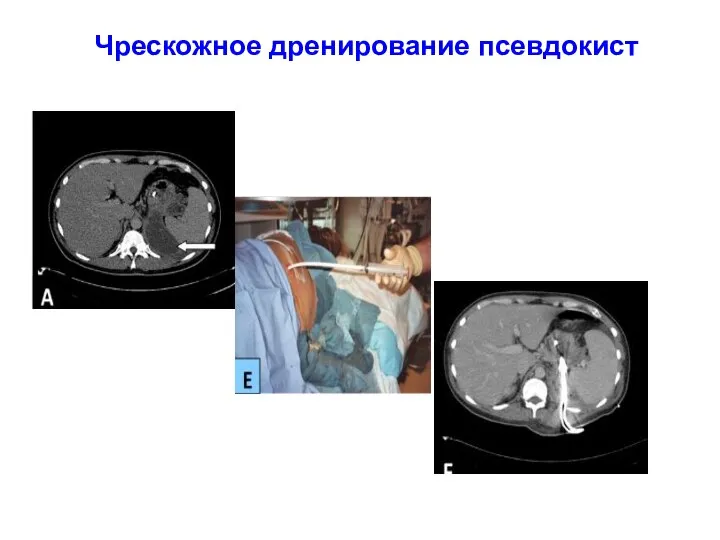 Чрескожное дренирование псевдокист