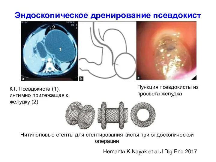 Эндоскопическое дренирование псевдокист Hemanta K Nayak et al J Dig End