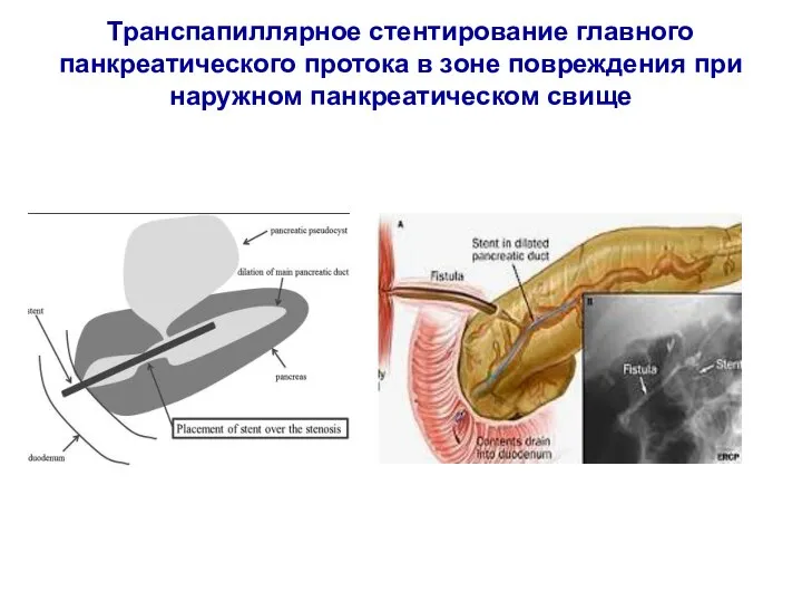 Транспапиллярное стентирование главного панкреатического протока в зоне повреждения при наружном панкреатическом свище