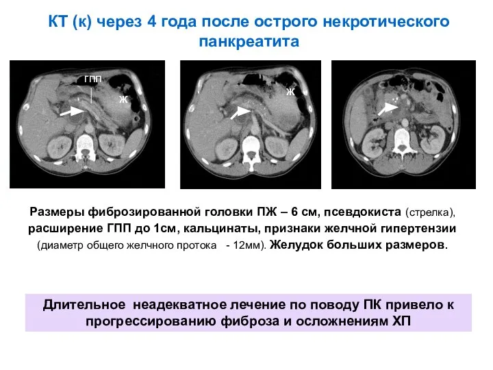 КТ (к) через 4 года после острого некротического панкреатита Размеры фиброзированной