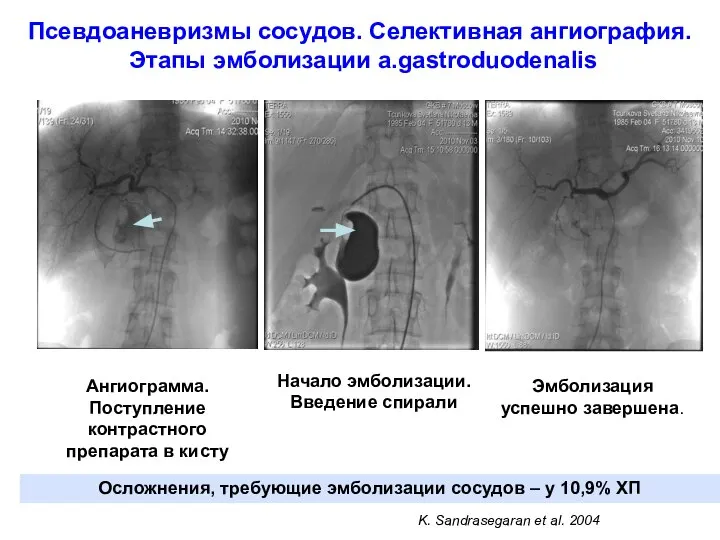 Псевдоаневризмы сосудов. Селективная ангиография. Этапы эмболизации a.gastroduodenalis Ангиограмма. Поступление контрастного препарата