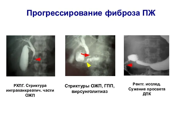 Прогрессирование фиброза ПЖ Рентг. исслед. Сужение просвета ДПК РХПГ. Стриктура интрапанкреатич.