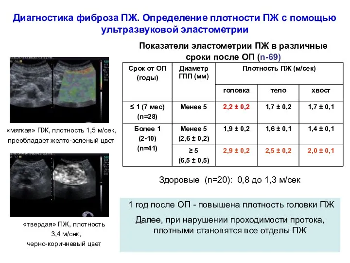 Показатели эластометрии ПЖ в различные сроки после ОП (n-69) 1 год