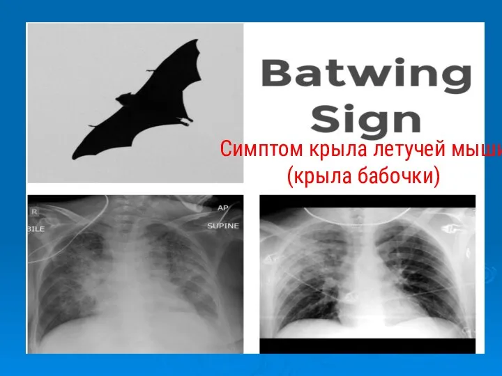 Симптом крыла летучей мыши (крыла бабочки)