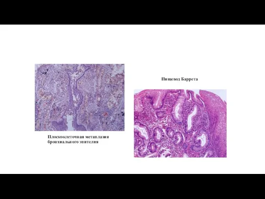 Плоскоклеточная метаплазия бронхиального эпителия Пищевод Баррета