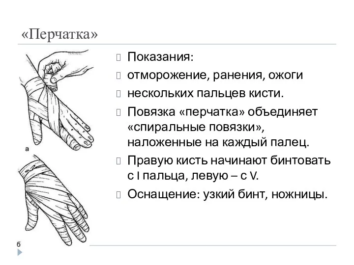 «Перчатка» Показания: отморожение, ранения, ожоги нескольких пальцев кисти. Повязка «перчатка» объединяет