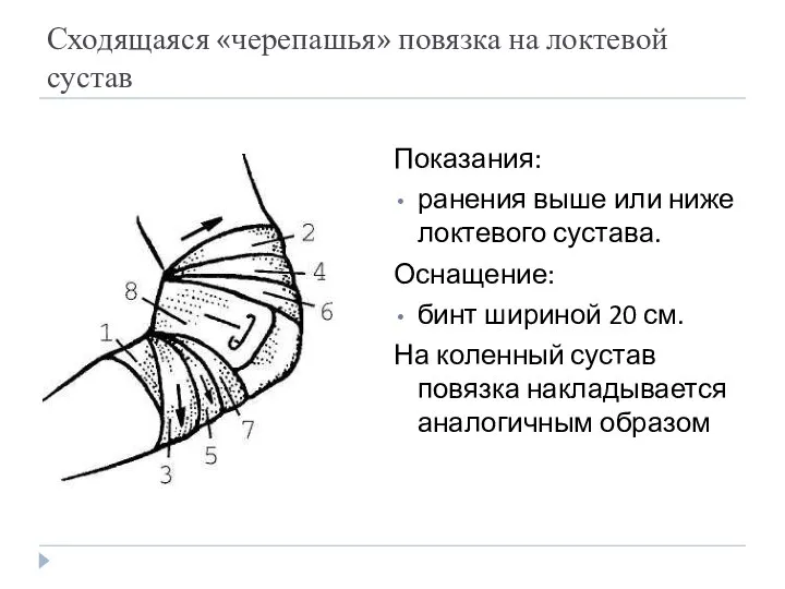 Сходящаяся «черепашья» повязка на локтевой сустав Показания: ранения выше или ниже