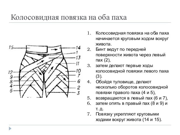 Колосовидная повязка на оба паха Колосовидная повязка на оба паха начинается