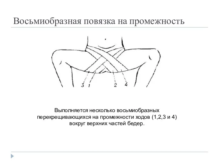 Восьмиобразная повязка на промежность Выполняется несколько восьмиобразных перекрещивающихся на промежности ходов