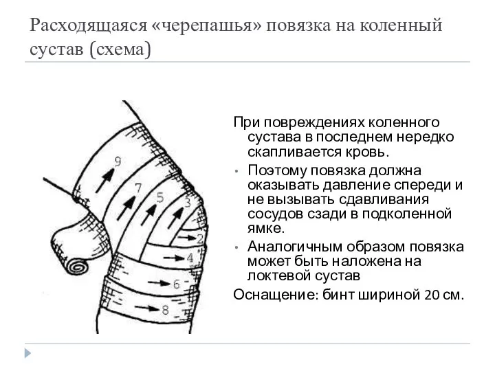 Расходящаяся «черепашья» повязка на коленный сустав (схема) При повреждениях коленного сустава