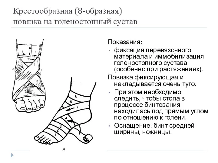 Крестообразная (8-образная) повязка на голеностопный сустав Показания: фиксация перевязочного материала и