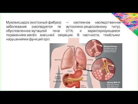 Муковисцидоз (кистозный фиброз) — системное наследственное заболевание (наследуется по аутосомно-рецессивному типу),