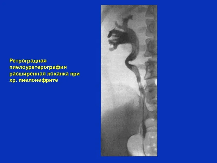 Ретроградная пиелоуретерография расширенная лоханка при хр. пиелонефрите