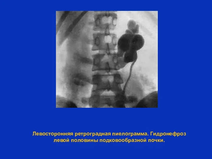 Левосторонняя ретроградная пиелограмма. Гидронефроз левой половины подковообразной почки.