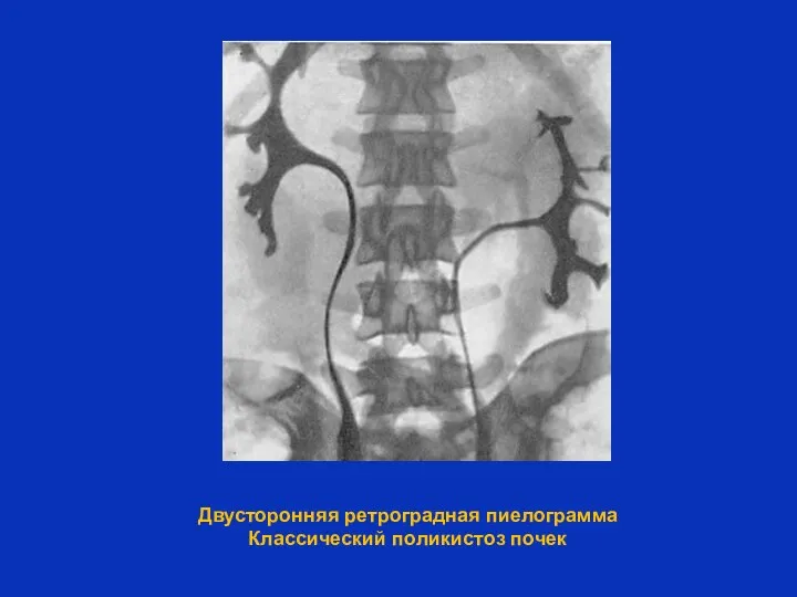 Двусторонняя ретроградная пиелограмма Классический поликистоз почек
