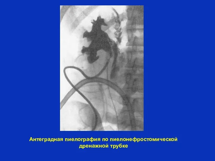 Антеградная пиелография по пиелонефростомической дренажной трубке