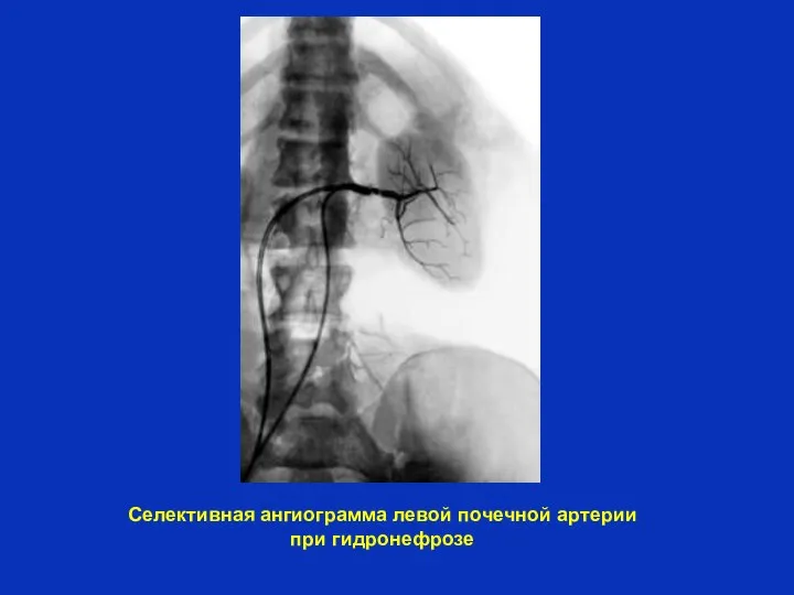 Селективная ангиограмма левой почечной артерии при гидронефрозе