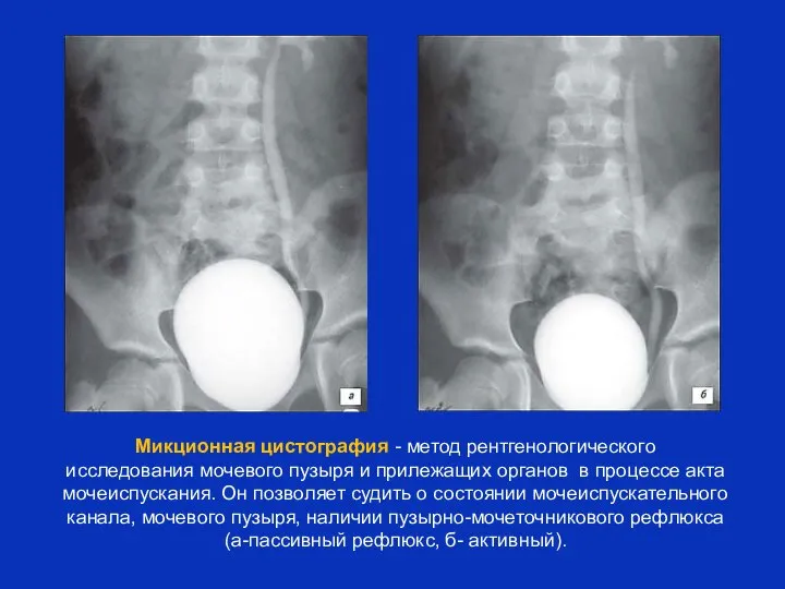 Микционная цистография - метод рентгенологического исследования мочевого пузыря и прилежащих органов