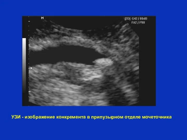 УЗИ - изображение конкремента в припузырном отделе мочеточника