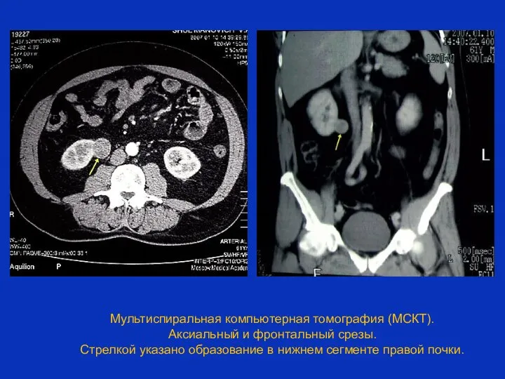 Мультиспиральная компьютерная томография (МСКТ). Аксиальный и фронтальный срезы. Стрелкой указано образование в нижнем сегменте правой почки.