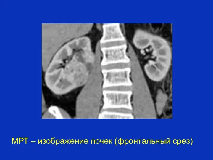 МРТ – изображение почек (фронтальный срез)