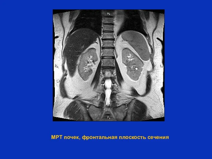 МРТ почек, фронтальная плоскость сечения