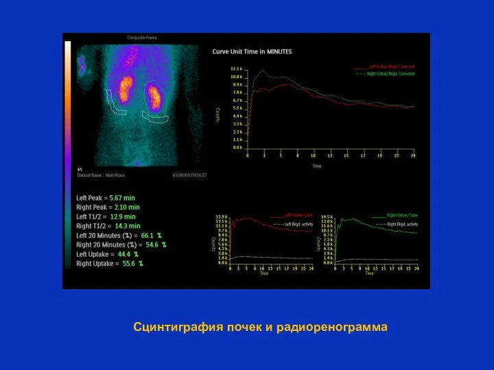 Сцинтиграфия почек и радиоренограмма