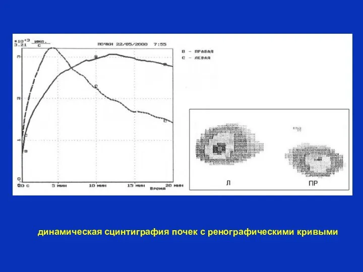 динамическая сцинтиграфия почек с ренографическими кривыми
