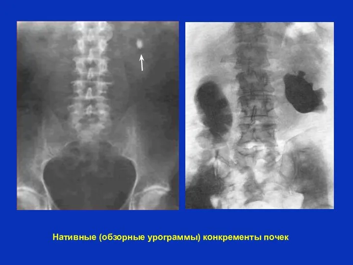 Нативные (обзорные урограммы) конкременты почек