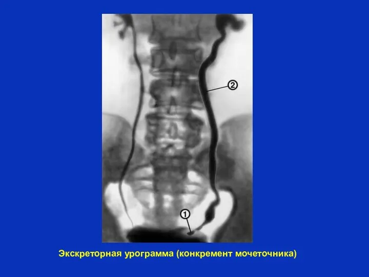 Экскреторная урограмма (конкремент мочеточника)