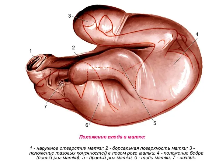 Положение плода в матке: 1 - наружное отверстие матки; 2 -