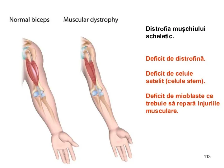 Distrofia mușchiului scheletic. Deficit de distrofină. Deficit de celule satelit (celule