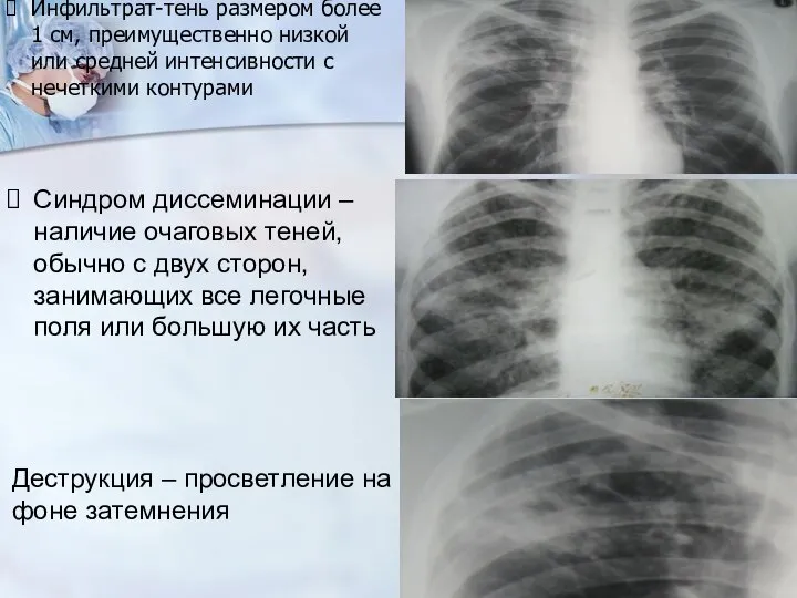 Инфильтрат-тень размером более 1 см, преимущественно низкой или средней интенсивности с