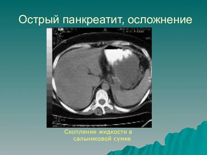 Острый панкреатит, осложнение Скопление жидкости в сальниковой сумке