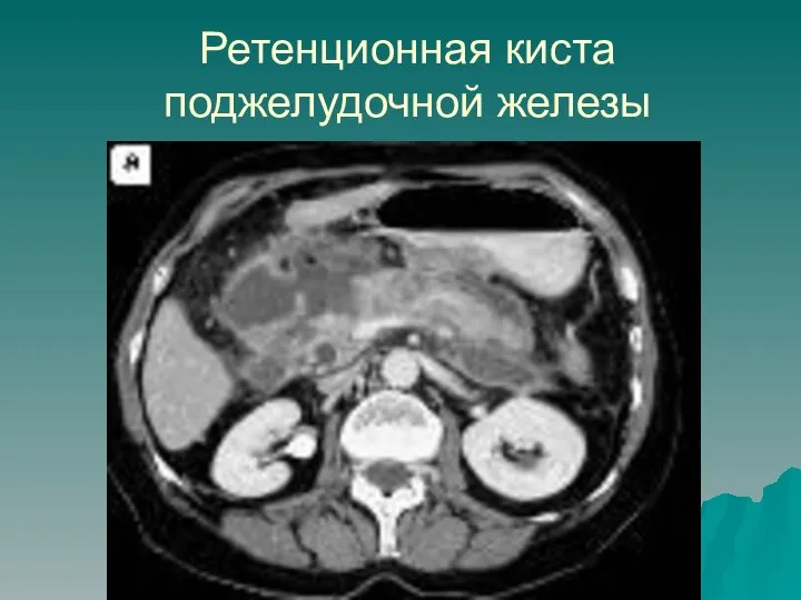 Ретенционная киста поджелудочной железы