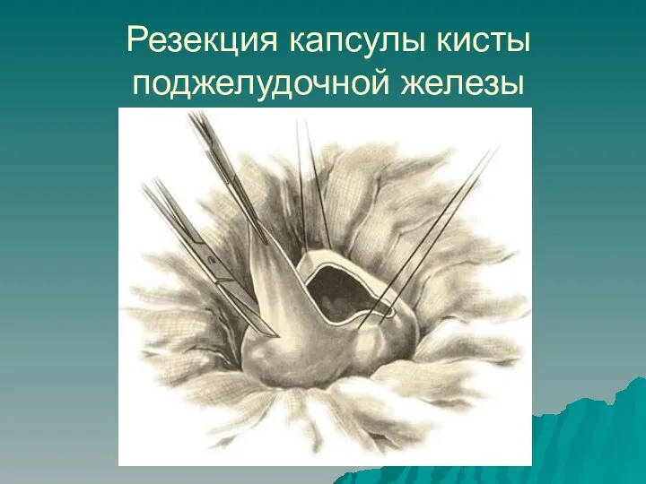 Резекция капсулы кисты поджелудочной железы