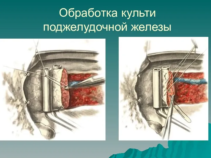 Обработка культи поджелудочной железы