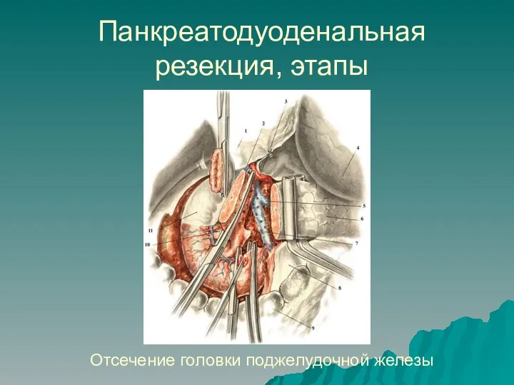 Панкреатодуоденальная резекция, этапы Отсечение головки поджелудочной железы