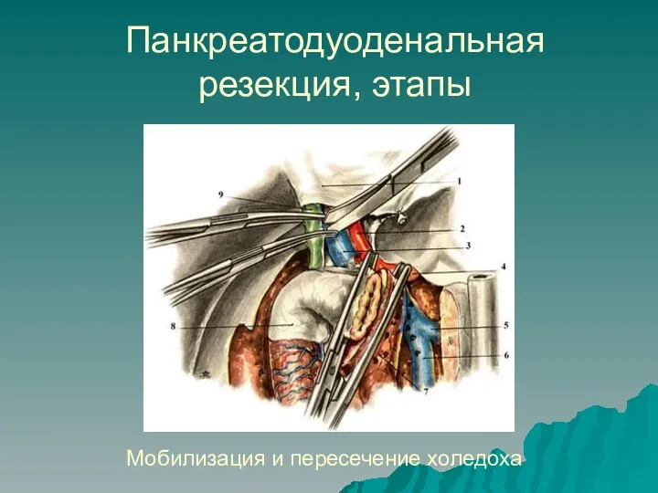 Панкреатодуоденальная резекция, этапы Мобилизация и пересечение холедоха